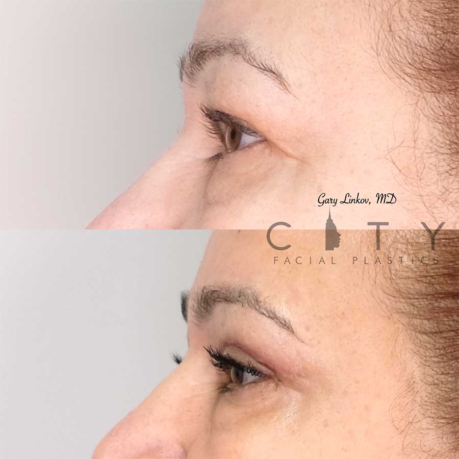 double eyelid surgery new york