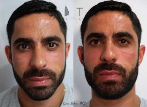 Cheek augmentation case 2 | NYC Cheek Augmentation/Lift, New York Implants, Fillers