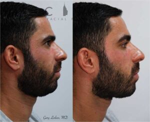 Cheek augmentation case 2 | NYC Cheek Augmentation/Lift, New York Implants, Fillers