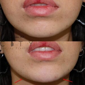 Chin augmentation Case 1 | NYC Chin Implants Surgery | New York Cosmetic Chin Augmentation