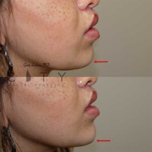 Chin augmentation Case 1 | NYC Chin Implants Surgery | New York Cosmetic Chin Augmentation