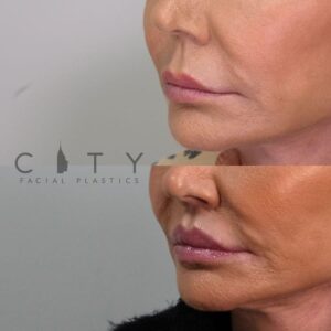 Elelyft Lip Lift Case 1 | Elelyft Upper Lip Lift, Dr. Gary Linkov Facial Plastic Surgeon