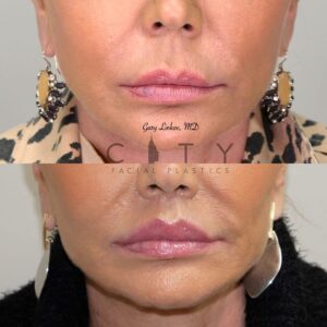 Elelyft Lip Lift Case 1 | Elelyft Upper Lip Lift, Dr. Gary Linkov Facial Plastic Surgeon