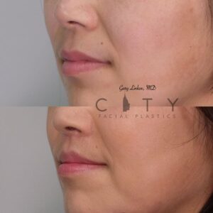 Elelyft Lip Lift Case 2 | Elelyft Upper Lip Lift, Dr. Gary Linkov Facial Plastic Surgeon