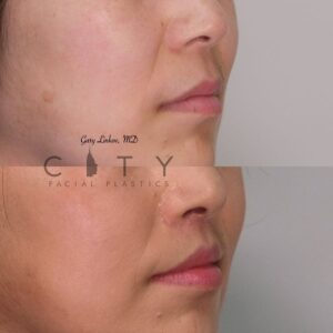 Elelyft Lip Lift Case 2 | Elelyft Upper Lip Lift, Dr. Gary Linkov Facial Plastic Surgeon