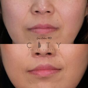 Elelyft Lip Lift Case 2 | Elelyft Upper Lip Lift, Dr. Gary Linkov Facial Plastic Surgeon