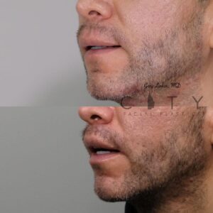 Elelyft Lip Lift Case 3 | Elelyft Upper Lip Lift, Dr. Gary Linkov Facial Plastic Surgeon