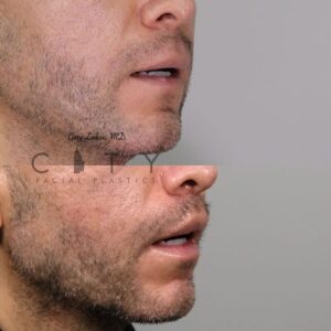 Elelyft Lip Lift Case 3 | Elelyft Upper Lip Lift, Dr. Gary Linkov Facial Plastic Surgeon