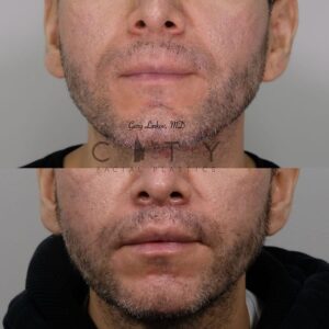 Elelyft Lip Lift Case 3 | Elelyft Upper Lip Lift, Dr. Gary Linkov Facial Plastic Surgeon