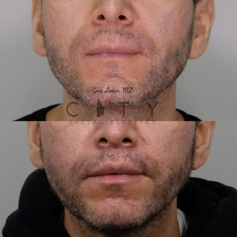 Elelyft Upper Lip Lift Dr. Gary Linkov Facial Plastic Surgeon New York