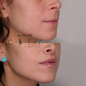 Elelyft Lip Lift Case 4 | Elelyft Upper Lip Lift, Dr. Gary Linkov Facial Plastic Surgeon