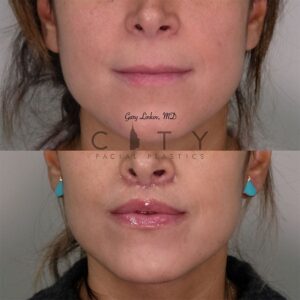 Elelyft Lip Lift Case 4 | Elelyft Upper Lip Lift, Dr. Gary Linkov Facial Plastic Surgeon