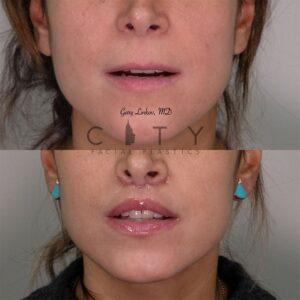 Elelyft Lip Lift Case 4 | Elelyft Upper Lip Lift, Dr. Gary Linkov Facial Plastic Surgeon