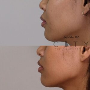 Elelyft Lip Lift Case 5 | Elelyft Upper Lip Lift, Dr. Gary Linkov Facial Plastic Surgeon