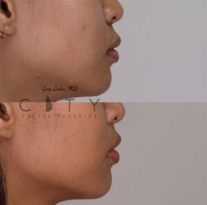Elelyft Lip Lift Case 5 | Elelyft Upper Lip Lift, Dr. Gary Linkov Facial Plastic Surgeon