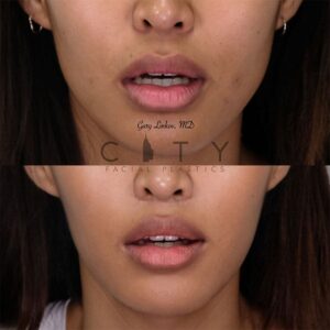 Elelyft Lip Lift Case 5 | Elelyft Upper Lip Lift, Dr. Gary Linkov Facial Plastic Surgeon