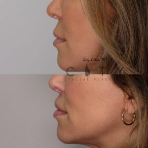 Elelyft Lip Lift Case 6 | Elelyft Upper Lip Lift, Dr. Gary Linkov Facial Plastic Surgeon