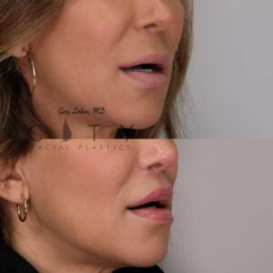 Elelyft Lip Lift Case 6 | Elelyft Upper Lip Lift, Dr. Gary Linkov Facial Plastic Surgeon