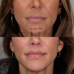 Elelyft Lip Lift Case 6 | Elelyft Upper Lip Lift, Dr. Gary Linkov Facial Plastic Surgeon