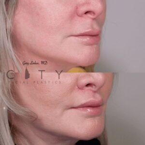 Elelyft Lip Lift Case 7 | Elelyft Upper Lip Lift, Dr. Gary Linkov Facial Plastic Surgeon