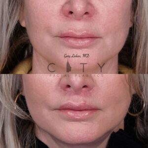 Elelyft Lip Lift Case 7 | Elelyft Upper Lip Lift, Dr. Gary Linkov Facial Plastic Surgeon