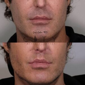 Elelyft Lip Lift Case 8 | Elelyft Upper Lip Lift, Dr. Gary Linkov Facial Plastic Surgeon