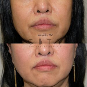 Elelyft Lip Lift Case 9 | Elelyft Upper Lip Lift, Dr. Gary Linkov Facial Plastic Surgeon