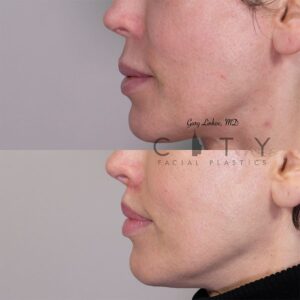 Elelyft Lip Lift Case 10 | Elelyft Upper Lip Lift, Dr. Gary Linkov Facial Plastic Surgeon