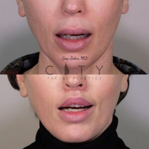 Elelyft Lip Lift Case 10 | Elelyft Upper Lip Lift, Dr. Gary Linkov Facial Plastic Surgeon