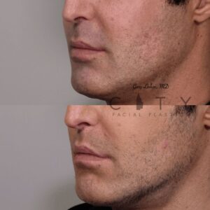 Elelyft Lip Lift Case 8 | Elelyft Upper Lip Lift, Dr. Gary Linkov Facial Plastic Surgeon