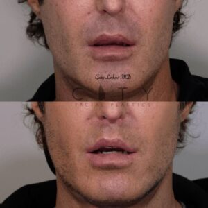 Elelyft Lip Lift Case 8 | Elelyft Upper Lip Lift, Dr. Gary Linkov Facial Plastic Surgeon