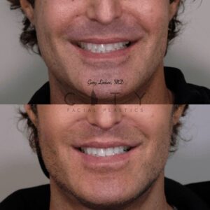 Elelyft Lip Lift Case 8 | Elelyft Upper Lip Lift, Dr. Gary Linkov Facial Plastic Surgeon