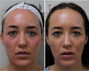 Facial Injectables Case 1 | NYC Facial Fillers Dermal Injections, New York Lip Fillers