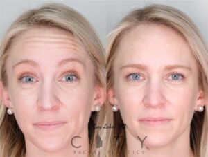 Facial Injectables Case 4 | NYC Facial Fillers Dermal Injections, New York Lip Fillers