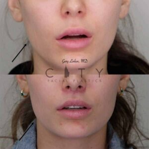 Facial Injectables Case 6 | NYC Facial Fillers Dermal Injections, New York Lip Fillers