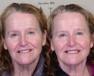 Facial Injectables Case 5 | New York Lip Fillers