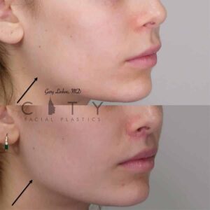 Facial Injectables Case 6 | NYC Facial Fillers Dermal Injections