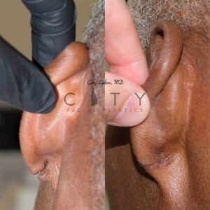 Facial reconstructive surgery case 1 | NYC Facial Reconstructive Plastic Surgery, New York Face Trauma