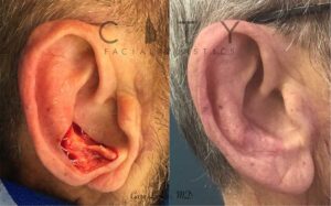 Facial reconstructive surgery case 2 | NYC Facial Reconstructive Plastic Surgery, New York Face Trauma