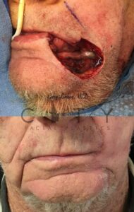 Facial reconstructive surgery case 3 | NYC Facial Reconstructive Plastic Surgery, New York Face Trauma