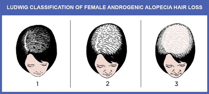 Types of Disease That Cause Hair Loss Manhattan, NYC - The Hair