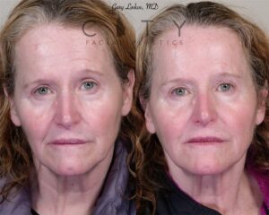 Forehead lift Case 2 | NYC Forehead/Brow Lift Surgery, New York Endoscopic Browlift