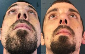 Functional Rhinoplasty Case 2 | New York Nose Reshaping Surgery