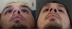 Functional Rhinoplasty Case 3 | New York Nose Reshaping Surgery