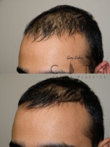 Hair loss treatment PRP Case 1 | NYC Alopecia Treatment, New York Therapy for Hair Loss