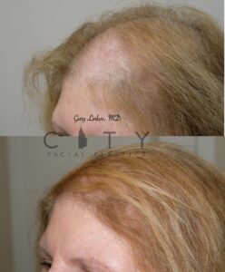 Hair loss treatment PRP Case 2 | NYC Alopecia Treatment, New York Therapy for Hair Loss