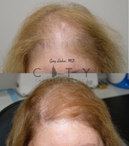 Hair loss treatment PRP Case 1 | NYC Female Hair Loss Treatment, New York Androgenic Alopecia Women
