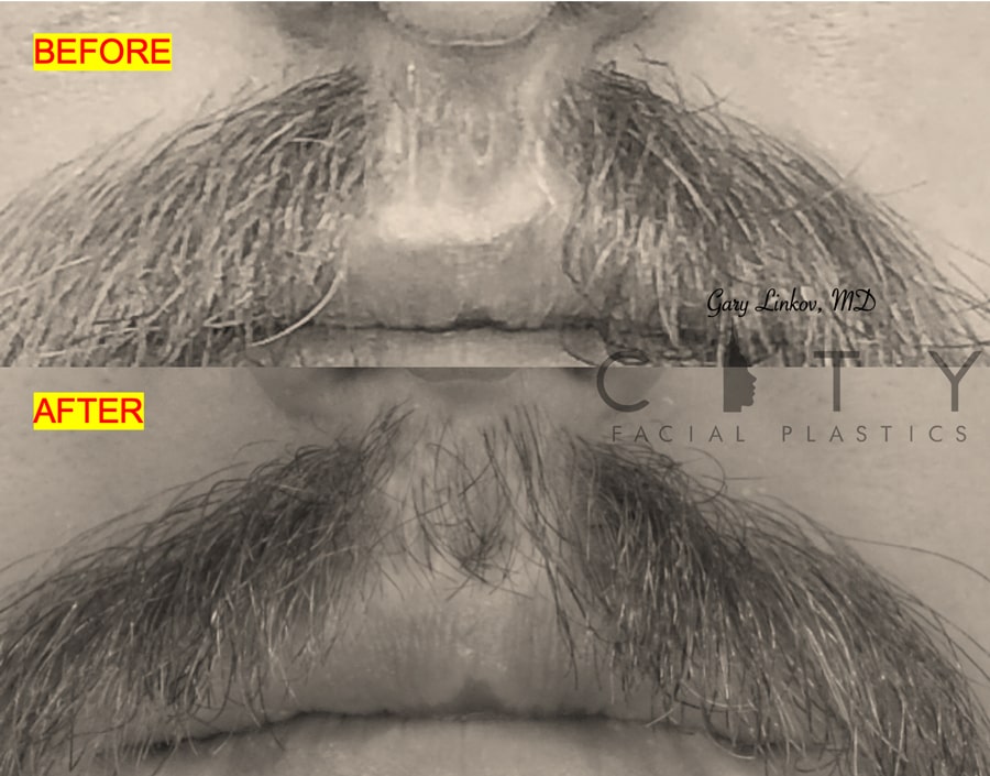 Hair transplant 2 mustache