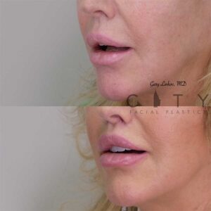 Lip Lift Revision Case 1 | NYC Lip Lift Revision Surgery