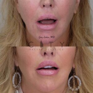 Lip Lift Revision Case 1 | NYC Lip Lift Revision Surgery